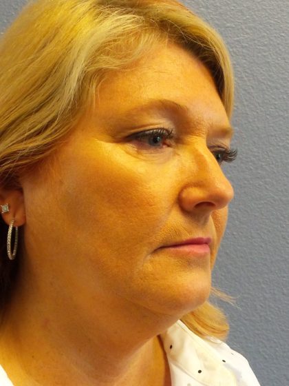 Liposuction of the Neck Before & After Patient #364