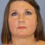 Liposuction of the Neck Before & After Patient #460