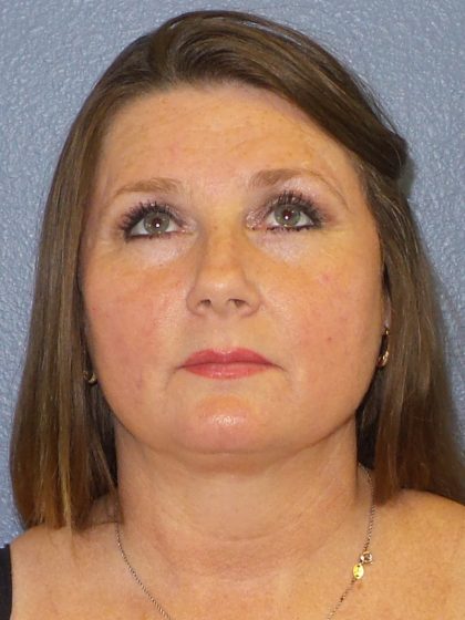 Liposuction of the Neck Before & After Patient #460