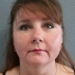 Liposuction of the Neck Before & After Patient #460