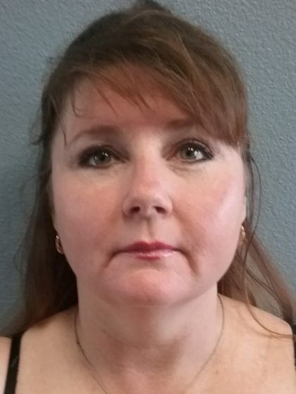 Liposuction of the Neck Before & After Patient #460