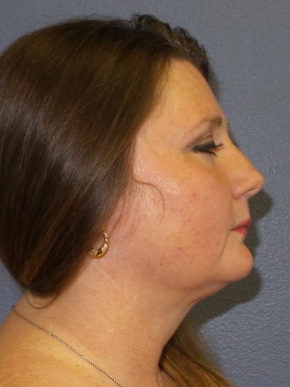 Liposuction of the Neck Before & After Patient #460