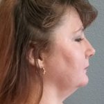 Liposuction of the Neck Before & After Patient #460