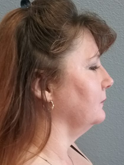 Liposuction of the Neck Before & After Patient #460