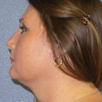 Liposuction of the Neck Before & After Patient #460