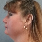 Liposuction of the Neck Before & After Patient #460
