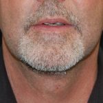 Liposuction of the Neck Before & After Patient #433