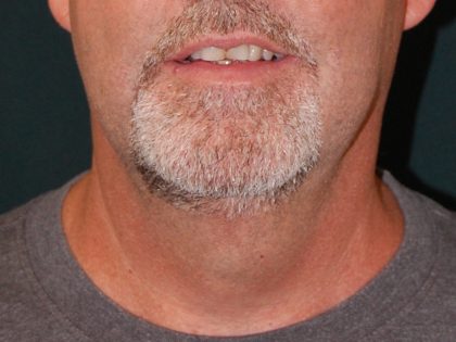 Liposuction of the Neck Before & After Patient #433