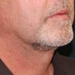 Liposuction of the Neck Before & After Patient #433