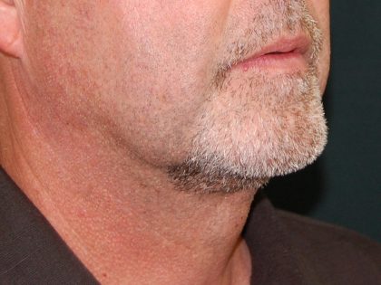 Liposuction of the Neck Before & After Patient #433