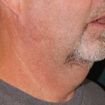 Liposuction of the Neck Before & After Patient #433