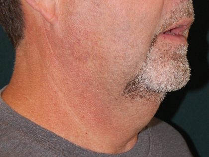 Liposuction of the Neck Before & After Patient #433