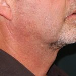 Liposuction of the Neck Before & After Patient #433