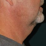 Liposuction of the Neck Before & After Patient #433