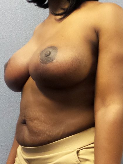 Breast Reduction Before & After Patient #1853