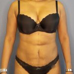 Liposuction Female Before & After Patient #1139