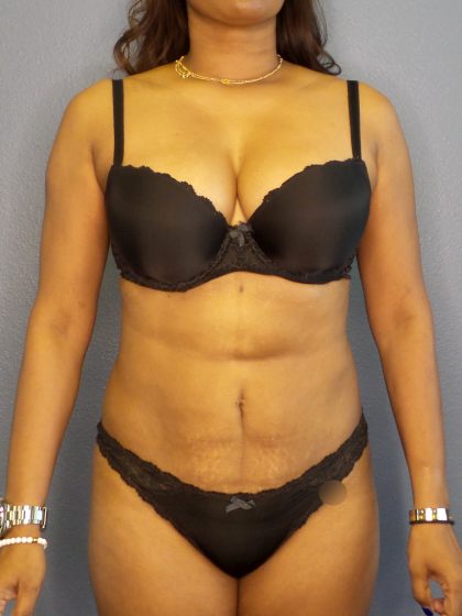 Liposuction Female Before & After Patient #1139