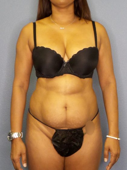 Liposuction Female Before & After Patient #1139