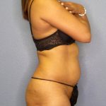 Liposuction Female Before & After Patient #1139