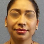 Liposuction of the Neck Before & After Patient #382