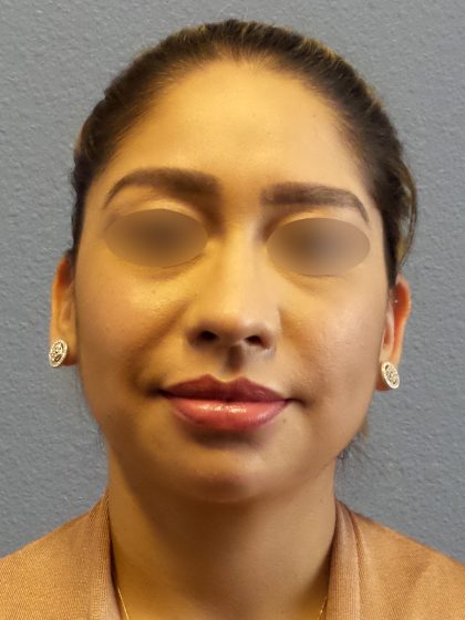 Liposuction of the Neck Before & After Patient #382