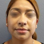 Liposuction of the Neck Before & After Patient #382
