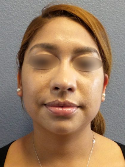 Liposuction of the Neck Before & After Patient #382