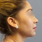 Liposuction of the Neck Before & After Patient #382