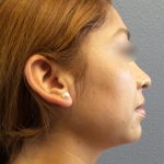 Liposuction of the Neck Before & After Patient #382