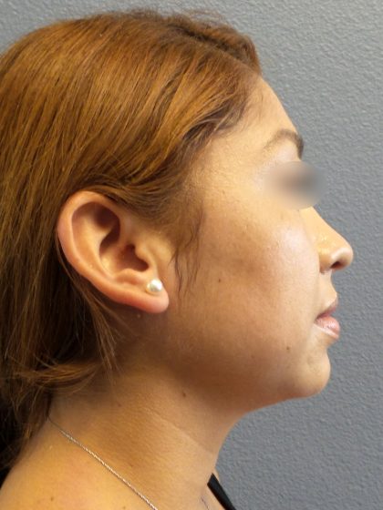 Liposuction of the Neck Before & After Patient #382