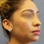 Liposuction of the Neck Before & After Patient #382