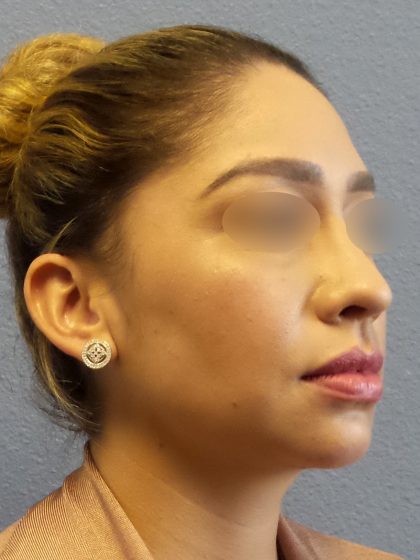 Liposuction of the Neck Before & After Patient #382