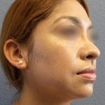 Liposuction of the Neck Before & After Patient #382