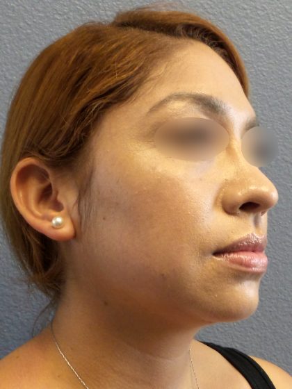 Liposuction of the Neck Before & After Patient #382