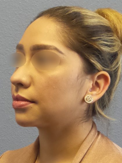 Liposuction of the Neck Before & After Patient #382