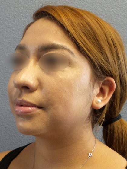 Liposuction of the Neck Before & After Patient #382