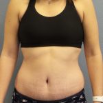 Abdominoplasty Before & After Patient #2240