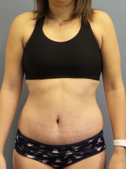 Abdominoplasty Before & After Patient #2240