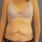 Abdominoplasty Before & After Patient #2240