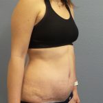 Abdominoplasty Before & After Patient #2240
