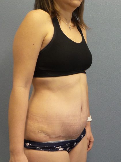 Abdominoplasty Before & After Patient #2240