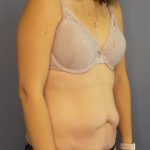 Abdominoplasty Before & After Patient #2240