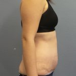 Abdominoplasty Before & After Patient #2240
