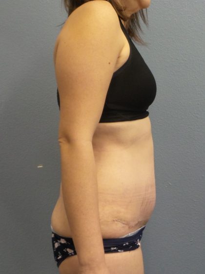 Abdominoplasty Before & After Patient #2240
