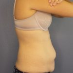 Abdominoplasty Before & After Patient #2240