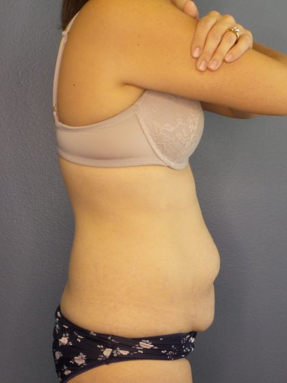 Abdominoplasty Before & After Patient #2240