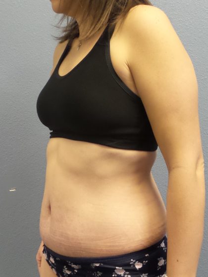 Abdominoplasty Before & After Patient #2240