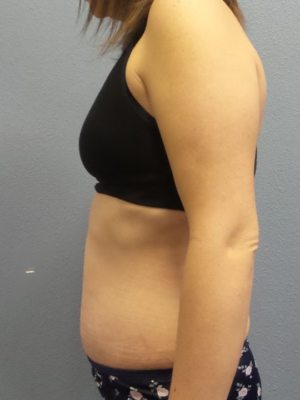 Abdominoplasty Before & After Patient #2240