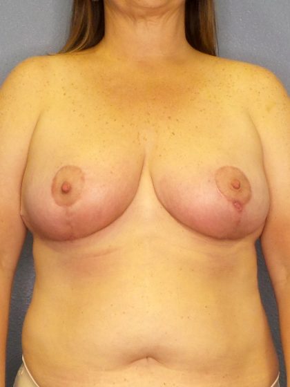 Breast Reduction Before & After Patient #1860