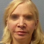 Facelift Before & After Patient #916
